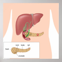 Affiche de cancer pancréatique