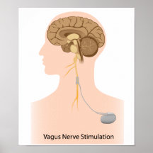 Affiche de thérapie de stimulation de nerf vague