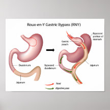 affiche gastrique de chirurgie de la déviation Rou