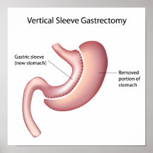 Affiche gastrique de chirurgie de perte de poids d