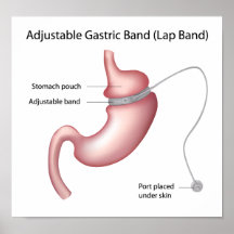 Affiche gastrique de chirurgie de perte de poids d