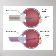 Astigmatism, a common eye defect Poster