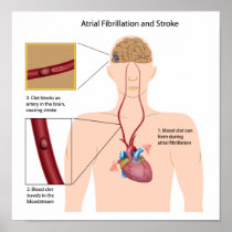 Atrial fibrillation and stroke Poster