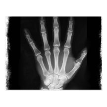 B&W X-ray Skeleton Hand Postcards