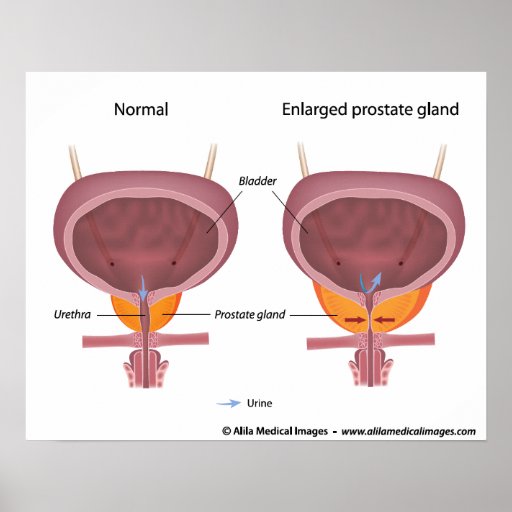 Benign Prostatic Hyperplasia, Labelled Diagram. | Zazzle