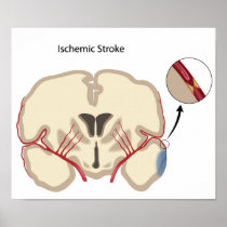 Brain ischemic stroke Poster