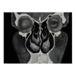 Cavity posters
