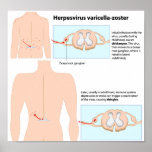 Chickenpox and Shingles Poster