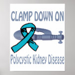 Clamp Down On Polycystic Kidney Disease Poster