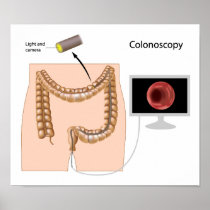 Colonoscopy procedure Poster