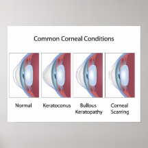 Common corneal conditions Poster