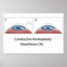 Conductive Keratoplasty (NearVision CK) Poster