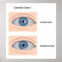 Corneal ulcer eye diseases Poster