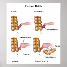 Crohns disease ileitis poster