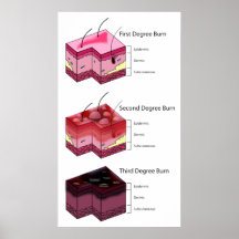 De peau de brûlure de deuxième d'abord diagramme e affiches