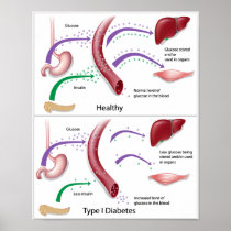 Diabetes type 1 Poster