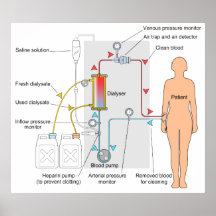 Diagram of a Haemodialysis Medical Treatment Print