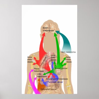 Diagram of Metastasis Sites for Common Cancers by chartsanddiagrams