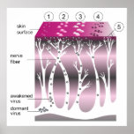 Diagram of the Progression of Shingles on Skin posters