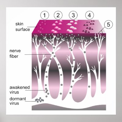 Diagram of the Progression of Shingles on Skin Poster by chartsanddiagrams