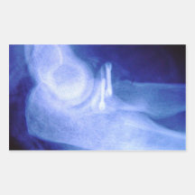 Elbow xray with screws sticker