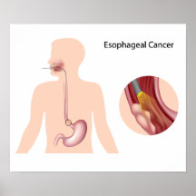 Esophageal cancer  Poster