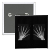 Extra Digit X-ray Right & Left Hands Pinback Buttons