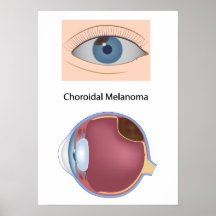 Eye disease Uveal melanoma Poster