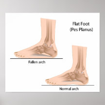 Flat foot Poster