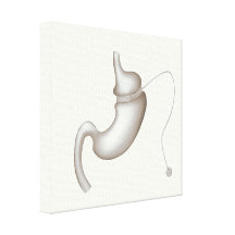 Gastric Band Weight Loss stretched canvas print