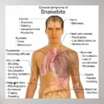 General Symtoms Chart of a Snakebite Poisoning posters