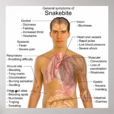 General Symtoms Chart of a Snakebite Poisoning Poster by chartsanddiagrams