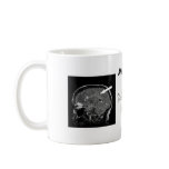 Get Personal With Your Lesion Load! Mugs