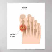 Goutte de l'affiche de gros orteil
