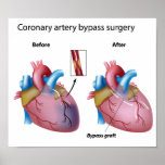 Heart bypass surgery  Any size Poster posters