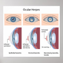 Herpes of the eye diseases Poster