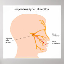 Herpesvirus infection (cold sores) print