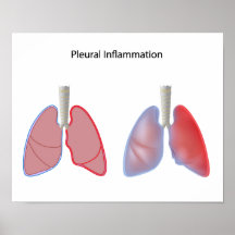 Inflammation of pleura, pleurisy Poster