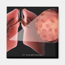 Inflammed airway during an asthma attack fridge magnets