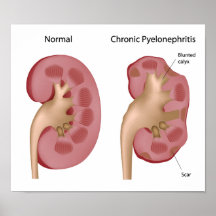 Kidney Chronic pyelonephritis Poster
