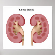 Kidney stone Poster