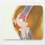 Knee replacement. Coloured X-ray of a total knee Mousepad