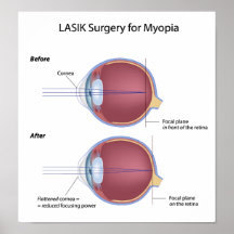 Lasik eye surgery for myopia print