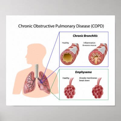 Copd Poster