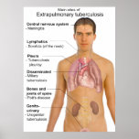Main Symptoms of Extrapulmonary Tuberculosis Chart posters