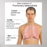 Main Symptoms of Pulmonary Tuberculosis Chart posters