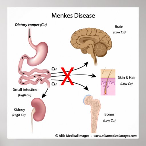 Menkes Syndrome  Labelled Diagram