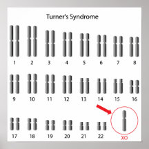 Monosomie X, affiche du syndrome de Turner
