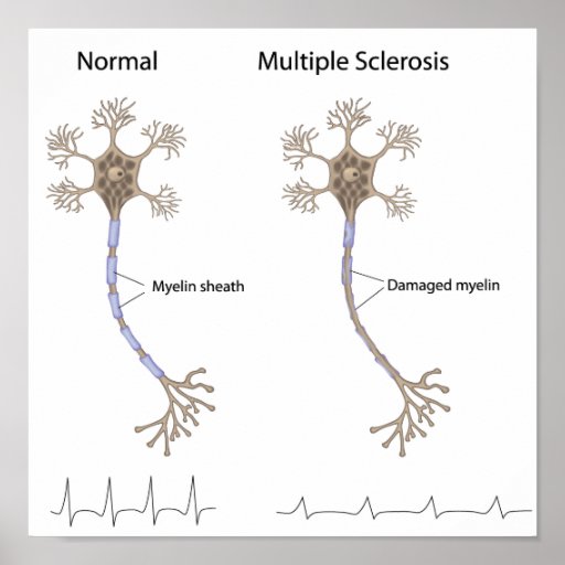 Multiple sclerosis disease Poster