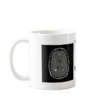 Multiple Sclerosis Coffee Mugs